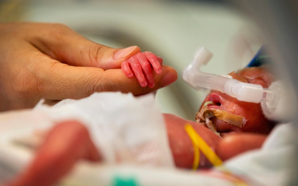 Baby Iris - one of the first neonatal babies to have her skin examined with the DeepLive Optical Coherence Tomography scanner. 