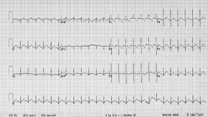 ECG, 2 month old