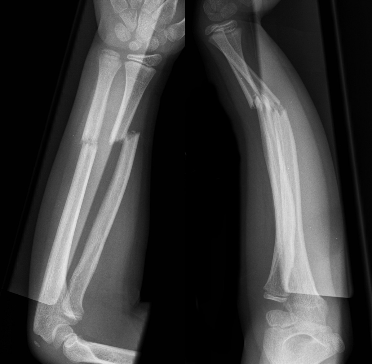 Transverse fractures of radius and ulna with complete displacement of radius and significant dorsal angulation