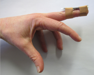 Splint affixed to the dorsum of the digit by two separate tapes.   